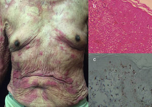 LLCTA crónica. (a) Varón de 91 años de edad con múltiples placas pruríticas y eritematosas en tronco de un año de evolución, asociadas a un cuadro de xerosis severa. (b) Epidermotropismo y absceso de Pautriers. Tinción con hematoxilina y eosina, ×40. (c) Inmunohistoquímica CD3+, ×40. El paciente falleció 4 meses después del ingreso. Estuvo en tratamiento paliativo y sintomático.