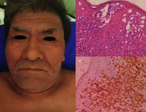 LLCTA crónica. (a) Varón de 66 años de edad con eritroderma y xerosis severa de 3 años de evolución. (b) Epidermotropismo y microabscesos de Pautriers. Tinción con hematoxilina y eosina, ×40. (c) Inmunohistoquímica CD3+, ×40. El paciente falleció 8 meses después de empezar un tratamiento con quimioterapia con gemcitabina (1.000mg/m2 cada día) y oxaliplatino (100mg/m2 cada día) cada 3 semanas.