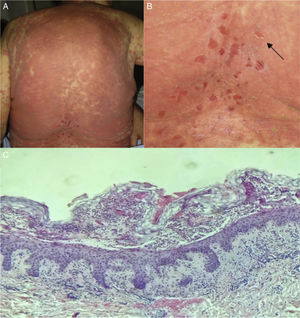 A y B) Áreas eritematovioláceas en la espalda, y signo de Nikolski positivo (flecha). C) Pústula subcórnea con abundantes neutrófilos (hematoxilina-eosina x200).