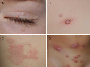 Diferentes aspectos clínicos de los MC. Lesiones de pápulas rosadas con típica umbilicación central en párpados A), lesión sésil de morfología menos típica junto a otras características de la infección B), reacción eccematiforme en torno a los MC (eccema-molusco), y lesiones inflamadas y abscesificadas en región abdominal D).