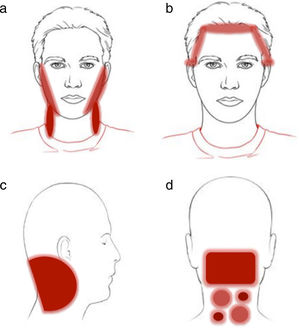 Patrones clínicos dermatitis de contacto alérgica en el cuero cabelludo. a) Patrón de lavado: placas de eccema en las caras laterales de la región facial (región preauricular y mandibular) y cuello; b) c) y d) patrón en la línea de implantación del pelo —b) región frontal y superior de las orejas, c) región occipital y retroauricular—.