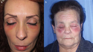 Dermatitis de contacto por gotas oftálmicas. a) Placas de eccema afectando principalmente a los párpados inferiores y a las mejillas; y b) en ocasiones además de los párpados inferiores y las mejillas también hay afectación de los párpados superiores.