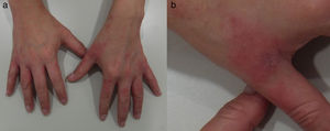 Dermatitis de contacto irritativa con patrón en delantal. a) Placas de eccema afectando los espacios interdigitales y el dorso de ambas manos; y b) detalle de la afectación interdigital.