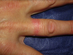 Patrón en anillo en paciente con dermatitis de contacto irritativa.