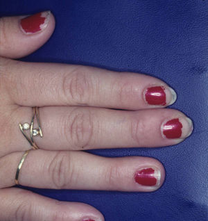Dermatitis de contacto alérgica con patrón periungueal.