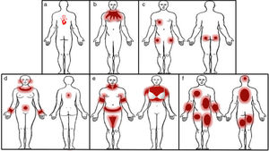 Patrones clínicos dermatitis de contacto alérgica en el tronco. a) Patrón geográfico; b) patrón de goteo; c) patrón de bolsillo; d) patrón níquel; e) patrón textil; y f) patrón generalizado parcheado.