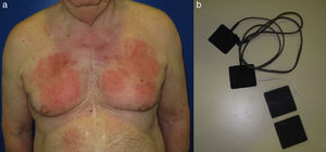 Dermatitis de contacto alérgica patrón geográfico por alergia a acrilatos en adhesivo de parches de electroestimulación nerviosa transcutánea. a) Placas de eccema que dibujan la figura de los parches; y b) parches de electroestimulación transcutánea.