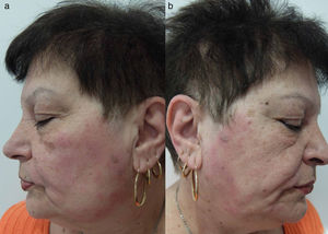 a) y b) Dermatitis de contacto alérgica por champú afectando ambos lados de la cara (patrón del lavado).