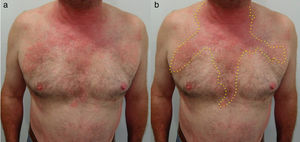 Dermatitis de contacto alérgica patrón de goteo. Paciente con dermatitis de contacto alérgica a Kathon CG® contenido en un jabón de uso diario. a) Placas de eccema que dibujan el recorrido del producto por la cara anterior del tórax; y b) detalle de la morfología de las lesiones.