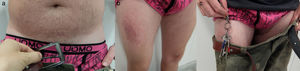 Dermatitis de contacto alérgica a níquel. a) Placa de eccema en la región infraumbilical por níquel presente en hebilla de cinturón; b) placa de eccema en el muslo derecho; y c) detalle de la relación de las llaves metálicas con la placa de eccema.