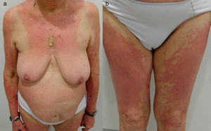 Dermatitis de contacto alérgica patrón textil. a) Placas de eccema afectando la cara interna de ambos brazos y los antebrazos. Afectación de escote respetando la zona del sujetador (no afectación de mamas y tirantes); y b) afectación de ambos muslos.