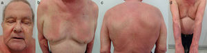 Dermatitis de contacto alérgica con patrón generalizado parcheado. a) Placas de eccema de distribución parcheada en la región frontal, las mejillas y el mentón; b) placas de eccema de distribución parcheada en la cara anterior del tronco; c) placas de eccema de distribución parcheada en la espalda; y d) placas de eccema de distribución parcheada en ambos antebrazos.