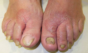 Dermatitis de contacto alérgica con patrón localizado por aplicación de crema antifúngica.