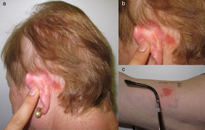 a) y b) Dermatitis de contacto alérgica por patilla de gafa; y c) prueba epicutánea positiva con viruta de gafas.