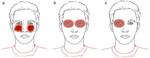 Patrones clínicos de dermatitis de contacto alérgica en los párpados. a) Patrón de goteo; b) patrón de contorno; y c) patrón palpebral unilateral.