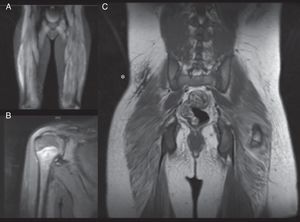 RMM de nuestros pacientes. A. Paciente 1. RMM-CE. Aumento de intensidad en secuencia STIR en región glútea y vasto lateral, indicativo de edema muscular, signo de inflamación muscular, que en el contexto del paciente confirma la miopatía. B. Paciente 4. RMM-hombro. Aumento de intensidad de la señal de deltoides derecho y fascia muscular, asociada a mínima cantidad de líquido en bursa subacromial. C. Paciente 5. RMM-CE tras instauración de tratamiento. Nótese la placa de calcinosis cutis en la región lumbar baja derecha (*) visualizada como una placa hipointensa.