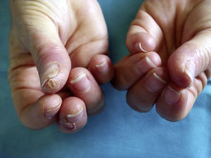 Lesiones clínicas características en las esteticistas: pulpitis seca fisurada de los primeros dedos de ambas manos con predominio de la mano dominante.
