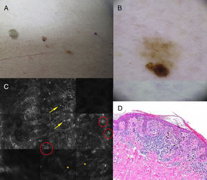 Clínica, dermatoscopia, microscopia confocal de reflectancia e histología (H&E ×100). A) Nevus en región lumbar de 4mm, de color marrón claro, con un área hiperpigmentada y asimetría. B) Signo de la isla: patrón dermatoscópico homogéneo reticular con un área excéntrica hiperpigmentada de un patrón diferente, que es reticular atípico. C) Células atípicas redondas aisladas (flechas), células atípicas formando nidos (círculos), y papilas de contornos mal definidos (asteriscos). D) Proliferación de melanocitos atípicos, grandes, con nucléolos prominentes e hipercromáticos que corresponden a la zona del signo de la isla.