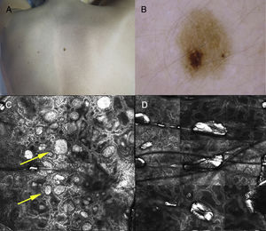 Clínica, dermatoscopia y microscopia confocal de reflectancia. A) Nevus en tronco posterior con un área hiperpigmentada. B) Signo de la isla: se observa una zona con un patrón con glóbulos de color marrón claro de morfología y distribución homogénea, que es diferente del resto de la lesión que presenta un patrón reticular. C) En la zona que corresponde al área de patrón globular se observa a nivel de la unión dermoepidérmica la presencia de un patrón globular formado por nidos densos (flechas), sin células atípicas. D) En la zona que corresponde al patrón reticular se observa un patrón en malla, sin células atípicas.