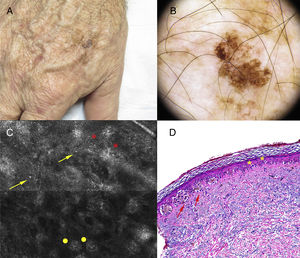 Clínica, dermatoscopia, microscopia confocal de reflectancia e histología. A) Lesión en dorso de mano derecha de 2cm, con un área hiperpigmentada de 6mm. B) Patrón homogéneo-reticular en la mayor parte de la lesión, con un área hiperpigmentada excéntrica de patrón globular atípico. C) En la zona que corresponde al patrón globular atípico se observa papilas de contornos mal definidos (asteriscos), nidos discohesivos (puntos) y células atípicas (flechas). D) Melanoma in situ, predominando el patrón lentiginoso, con células aisladas con ascenso pagetoide (asteriscos) y algunos grupos celulares (flechas) (H&E ×100).