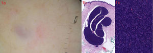 a. Dermatoscopia (DermLite II Pro HR, 3Gen): zona azul-violácea central, rodeada de un halo eritematoso. b. Tumoración bien delimitada, polilobulada, situada en la dermis (H-E×2). c. La tumoración está constituida por una proliferación epitelial bifásica, que consta de células de pequeño tamaño dispuestas alrededor de células con citoplasma más amplio y claro que forma estructuras ductales. Ausencia de atipias o figuras de mitosis (H-E×20).