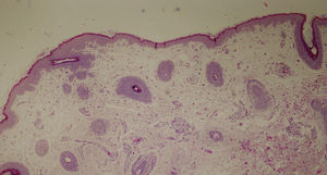 La muestra de la biopsia del cuero cabelludo reveló la presencia de estructuras pilosas rudimentarias y ausencia total de glándulas sebáceas, lo cual es consistente con el diagnóstico de displasia ectodérmica (hematoxilina-eosina, 10x).