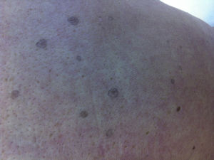 Máculas ovaladas de color marrón-grisáceo, levemente palpables, bien delimitadas, de entre 2 y 5mm de diámetro, muchas de ellas con correlatos de escamas.