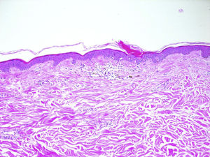 La histopatología (tinción hematoxilina-eosina; ampliación ×10) revela el típico patrón de la poroqueratosis con columna central de paraqueratosis (lamela cornoide) y queratinocitos disqueratósicos.