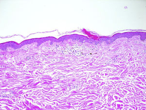 La histopatología (tinción hematoxilina-eosina; ampliación ×10) revela el típico patrón de la poroqueratosis con columna central de paraqueratosis (lamela cornoide) y queratinocitos disqueratósicos.