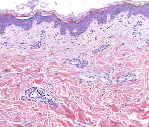 Dilatación vascular con infiltrado linfocítico perivascular de carácter leve. No se observa presencia de agentes mucinosos ni fúngicos Examen histopatológico (H&E ×10).