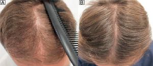 Varón de 28 años con MAGA y tratamiento con dutasterida 0,5mg/día y minoxidil 5% en aplicación nocturna. A. Pretratamiento. B. 12 meses postratamiento.