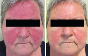 Agravamiento clínico tras doxiciclina oral (A) y resolución completa de las lesiones inflamatorias con azitromicina oral, persistiendo un leve eritema residual (B).