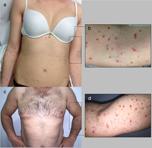 presentación clínica de PLEVA en paciente 1 (a-b) y 2 (c-d) con presencia de pápulas costrosas, descamativas y eritematosas, y pequeñas placas en tronco y extremidades.