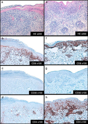 Histopatología e inmunohistoquímica de muestras cutáneas en paciente. 1 (a-d) y 2 (e-h).