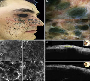 a) Aspecto clínico de la lesión pigmentada. b) Características dermoscópicas. c) Microscopia confocal de reflectancia en esquina superior izquierda: capa espinosa-granular de la epidermis. Esquina superior derecha: unión dermoepidérmica y dermis superior. Esquina inferior izquierda: dermis superior. Esquina inferior derecha: dermis reticular. d) Imágenes de tomografía por coherencia óptica.