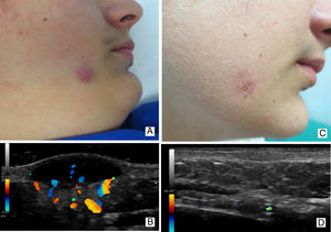 Caso 3: GAFI en varón de 12 años con lesiones cutáneas de rosácea asociadas. Imagen clínica (3A) y ecográfica (3B) de un GAFI en su fase activa o inflamatoria. Imagen clínica (3C) y ecográfica (3D) de la misma lesión, 6 meses más tarde.