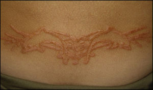 Eczema sobre tatuaje de henna; nótese la delimitación del mismo por las lesiones.