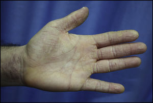 Eczema crónico hiperqueratósico que afecta palma, cara palmar de los dedos y cara anterior de la muñeca en profesional de la peluquería con positividad en pruebas epicutáneas a PPD y tiuram.