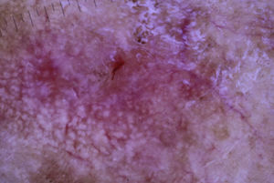 Imagen dermatoscópica de una de las lesiones donde se aprecia eritema, descamación y seudoretículo eritematoso de patrón «en fresa».