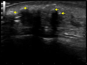 Imagen de la ecografía dermatológica (modo M, sonda 18MHz), donde se aprecian lesiones hiperecogénicas (flechas amarillas) con sombra acústica posterior en el tejido celular subcutáneo, compatibles con calcinosis.