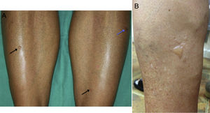 A) Pequeñas ampollas sobre piel sana en la cara anterior de ambas piernas (flechas negras) y erosión secundaria (flecha azul) (paciente 4). B) Múltiples ampollas de diferentes tamaños agrupadas en la cara lateral de la pierna izquierda (paciente 1).