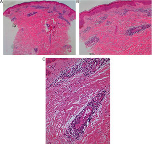A: ×40; B: ×100; C: ×200. El análisis histopatológico realizado (tinción hematoxilina-eosina) reveló una epidermis sin cambios significativos y un infiltrado histiolinfocítico perivascular tanto en la dermis superficial como en la dermis profunda. No se observó evidencia alguna de vasculitis.