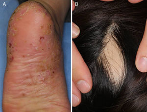 Se muestran figuras representativas. El caso 2 comenzó con lesión plantar de PPP (A) y alopecia areata (B).