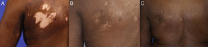 Área con hipo- e hiperpigmentación en parte superior de la espalda A) como presentación inicial, B) repigmentada al 90%, C) y repigmentación casi completa con el tratamiento con valaciclovir.