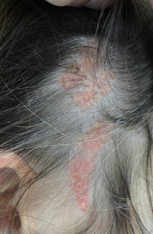 Nevus sebáceo lineal en una paciente de 20años. Obsérvese el aspecto papilomatoso y el color amarillento.