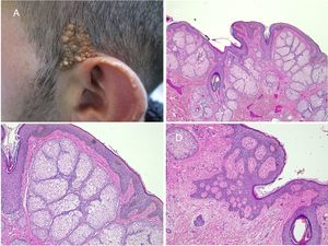 Nevus sebáceo en región temporal izquierda de un paciente joven. A)Imagen clínica. B(HE, 4×): imagen histológica que muestra la presencia de acantosis epidérmica y múltiples glándulas sebáceas de gran tamaño que se encuentran anormalmente altas en la dermis reticular. C(HE, 10×): detalle de las glándulas sebáceas. D(HE, 10×): la acantosis adquiere en algunas áreas un aspecto reticulado que recuerda a la queratosis seborreica adenoide.