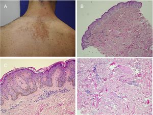 Nevus de Becker. A)Imagen clínica. B(HE, 4×): imagen panorámica que muestra la presencia de acantosis, hiperpigmentación de la basal y la presencia de fibras de músculo liso en la dermis reticular. C(HE, 10×): detalle de los cambios epidérmicos. D(HE, 10×): detalle de la presencia de fibras de músculo liso en la dermis reticular.