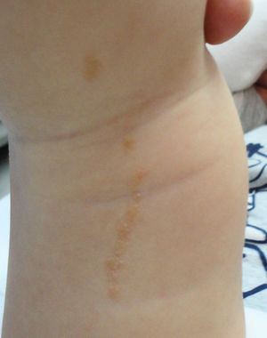 Nevus epidérmico lineal siguiendo las líneas de Blaschko.