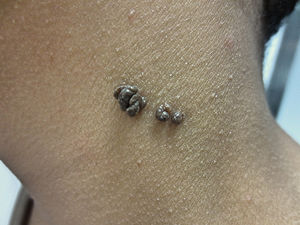 Nevus verrugoso. Algunos nevus queratinocíticos adquieren una superficie francamente papilomatosa.