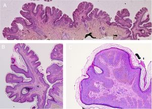 Nevus verrugoso de la nuca. Imagen histológica. A) Hematoxilina-eosina, HE, 2x: la epidermis muestra acantosis, papilomatosis e hiperqueratosis. B) HE, 4x: detalle de la epidermis papilomatosa. C) HE, 10x: mayor detalle de la acantosis, la presencia de hiperpigmentación de la basal y la hiperqueratosis ortoqueratósica laxa, en «cesta de mimbre».